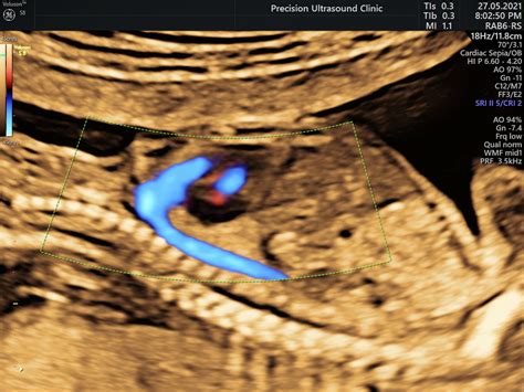 18 20 Weeks Scan Detailed Anomaly Scan