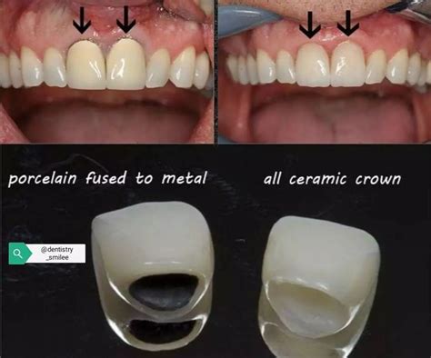 Porcelain Fused To Metal Crown Before And After