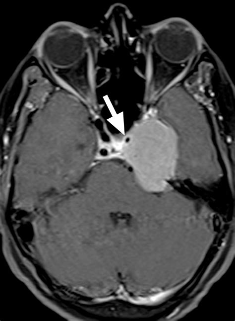 Imaging Spectrum Of Cavernous Sinus Lesions With Histopathologic