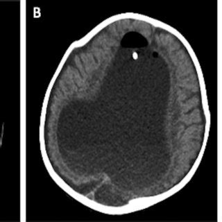 Ventriculitis in MRI. A Axial and B sagittal images of brain MRI after ...