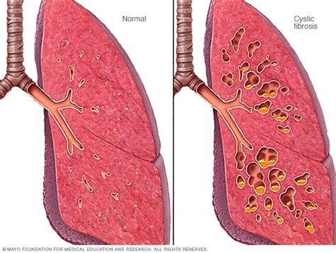 Cystic Fibrosis Lungs Vs Healthy Lungs