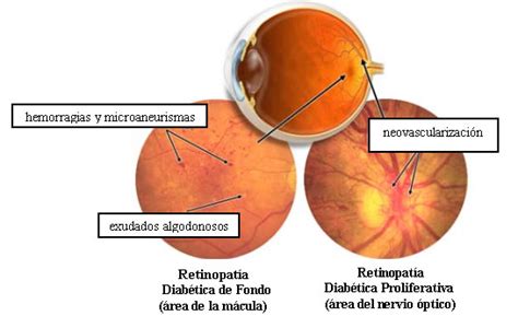 Panamericano de Ojos Qué es la Retinopatía Proliferativa