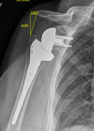 Uw Shoulder And Elbow Academy Reverse Shoulder Arthroplasty With Two