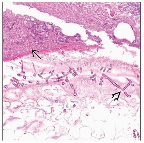 Zygomycosis | Basicmedical Key