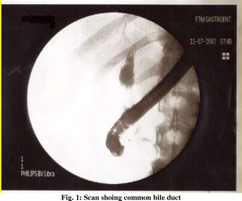 Figure 1 From Non Homogenous Filling Defect Related To Taenia Saginata