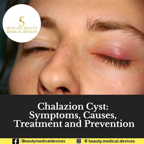 Chalazion Cyst Symptoms Causes Treatment And Prevention