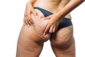 Good News About Cellulite Treatment Stop Worrying And Take Action