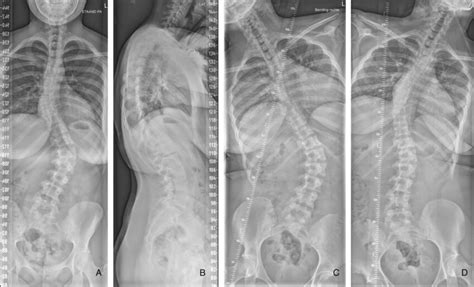 Example Of A Typical Posterior Anterior A Lateral B And Side Bending