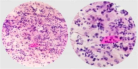 Paps smear. Microscopic examination of pap smear showing inflammatory ...