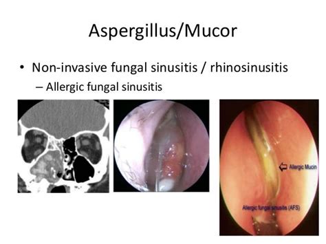 Granulomatous Diseases In Ent