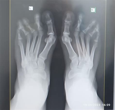 Went to the podiatrist yesterday to find out how bad my feet actually