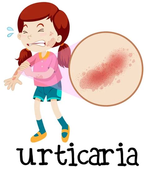 Gráfico Vectorial Urticaria Imagen Vectorial Urticaria Depositphotos®