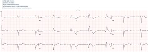 Ecg Interpretation In Epigastric Pain Vomiting Ecg Cases