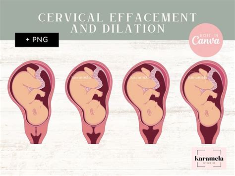 Cervical Effacement And Dilation Png Images Canva Pdf Etsy Uk In