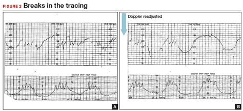 Fetal Heart Rate Patterns