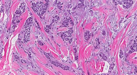 Basal Cell Carcinoma Of The Skin Ottawa Atlas Of Pathology