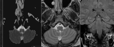 Radiology MRI: Wallenberg Syndrome - Lateral Medullary Syndrome