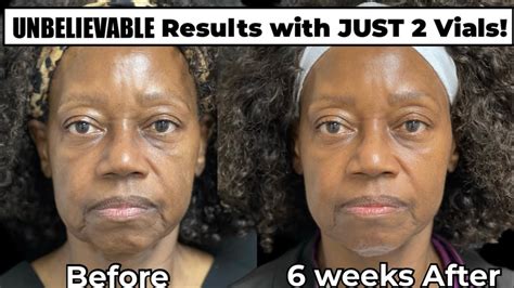 Incredible Sculptra Before And After In Only 6 Weeks Youtube