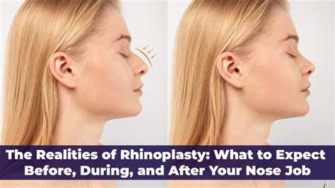 Rhinoplasty In Turkey What To Expect About Your Nose Job