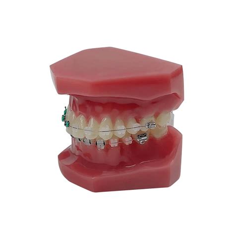 Normal Dental Orthodontic Teeth Model With Brace Half Metal Half