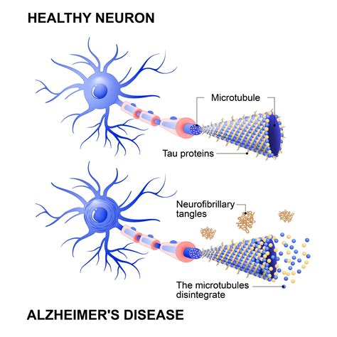 Key Differences Between Primary Age Related Tauopathy And Alzheimers