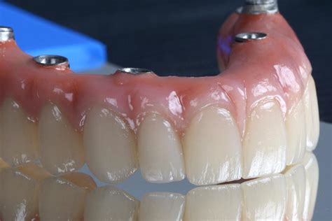 Proteza Fixa Pe Implanturi Implant Dentar All On All On