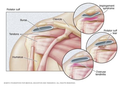 Rotator Cuff Tear Symptoms And Treatment Taylor Warren Weidner