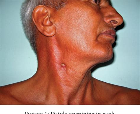 Figure 1 From Unusual Cause Of Orocutaneous Fistula In The Neck