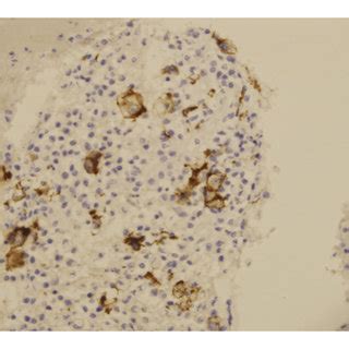 Right paratracheal lymph node biopsy via EBUS-TBNA with Papanicolaou ...