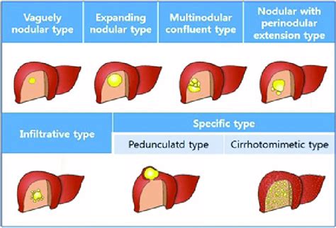 Hepatocellular Carcinoma Gross