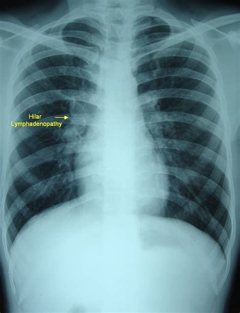 Hilar Lymphadenopathy – X-ray « PG Blazer