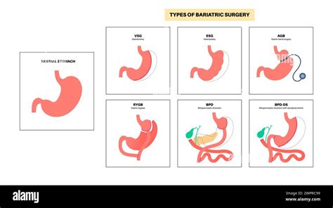 Types of bariatric surgery, illustration Stock Photo - Alamy