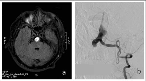 Figure From Endovascular Treatment For Ischemic Stroke Induced By