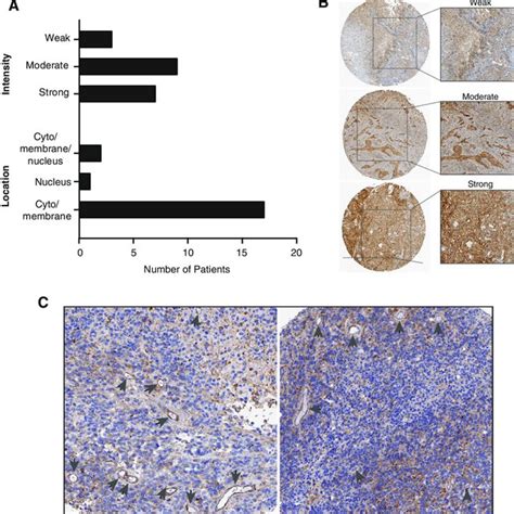 Expression of integrin subunit αv in human glioblastoma visualized by