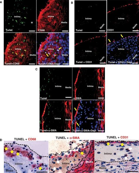 Cytotoxic And Proinflammatory Cd8 T Lymphocytes Promote Development Of Vulnerable