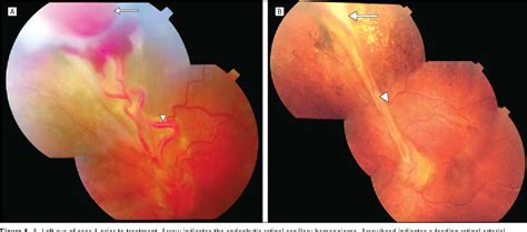 Retinal Capillary Hemangioma Semantic Scholar