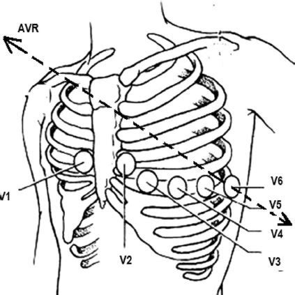 ECG after the correction of the misplaced right hand and left leg... | Download Scientific Diagram