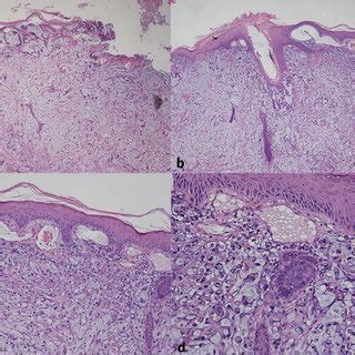 Cutaneous Metastases Of Signet Ring Cell Colorectal Adenocarcinoma