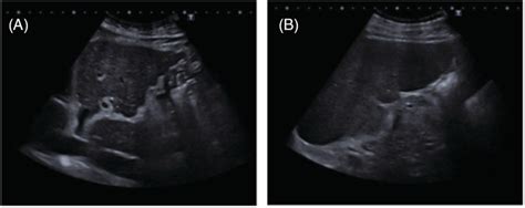 Liver ultrasound. (A) Cirrhotic liver with enlargement of the left lobe ...