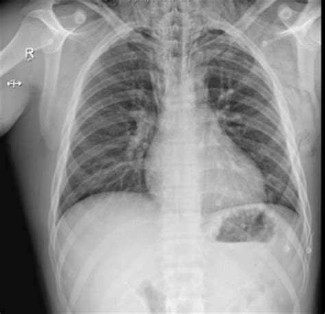 Posterior Anterior Pa Chest X Ray Shows A Pneumomediastinum And Download Scientific Diagram