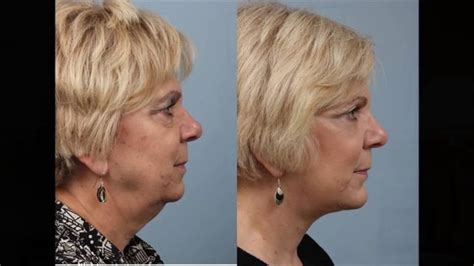 Sagging Neck Dr Edwin Williams Goes Over The Best Treatments To Help