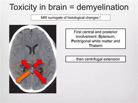 X Linked Adrenoleukodystrophy Radiological Assessment Ppt