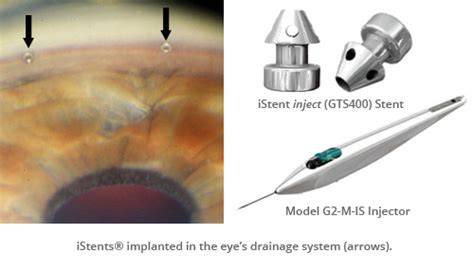 Minimally Invasive Glaucoma Surgery University Eye Specialist