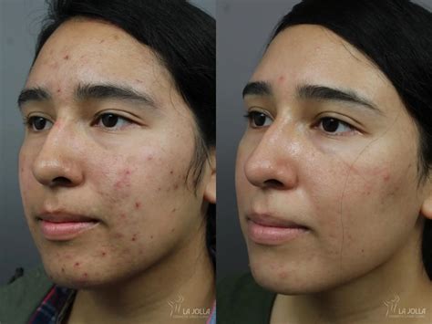 Acne Scars Before After Gallery Patient 8