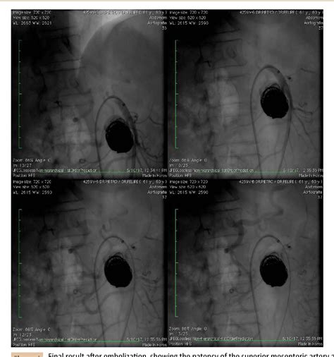 Figure 4 From Embolization Of Superior Mesenteric Artery Aneurysm With