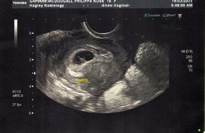 My Twins Ultrasound at 6 Weeks - Identical or Not?