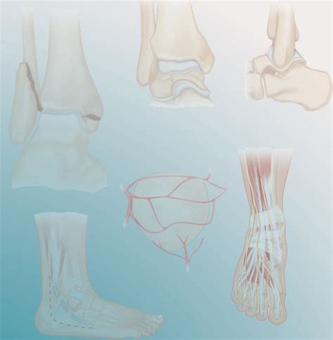 38: Repair of Tarsometatarsal Joint (Lisfranc) Fracture-Dislocation ...