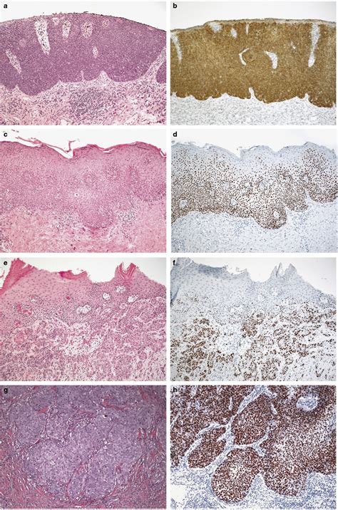 Hpv Negative Penile Squamous Cell Carcinoma Disruptive Mutations In The Tp53 Gene Are Common