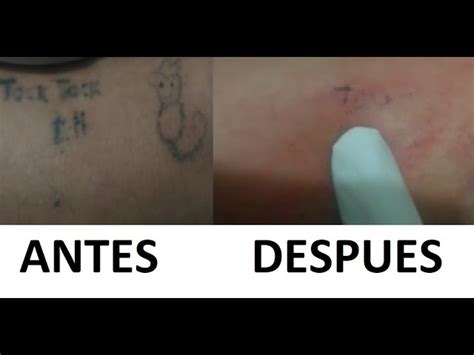 M Todos Caseros Sobre C Mo Borrar Un Tatuaje Reci N Hecho Econom A