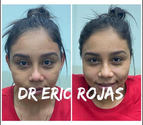 Modelado De Orejas Dr Eric Rojas Dermatolog A Laser Center